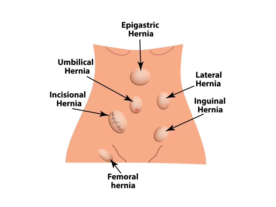 Common Types of Hernia in Children - KYM Hernia Surgeon