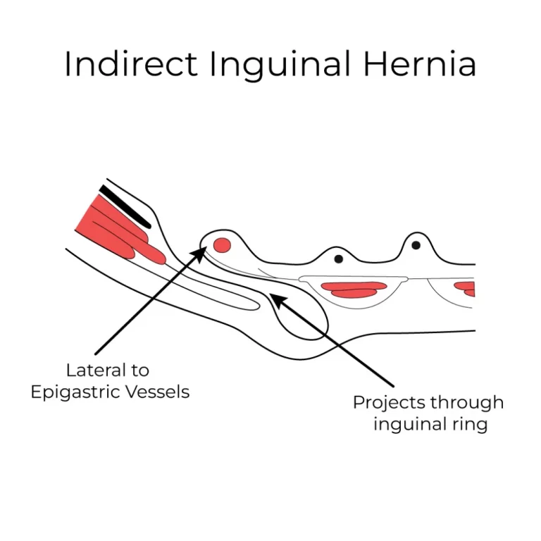 Indirect inguinal hernia: tissue enters the inguinal canal through its inner opening, to the side of the epigastric vessels