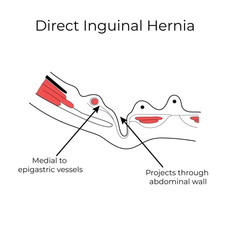 Direct inguinal hernia: tissue pushes straight through the back wall of the inguinal canal, on the inner side of the epigastric vessels